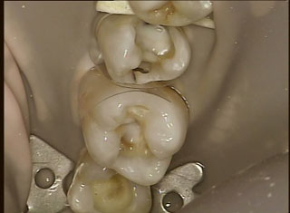 idea behind molar composite filling