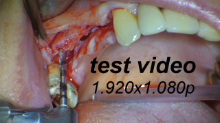 video thirdeye uni implant