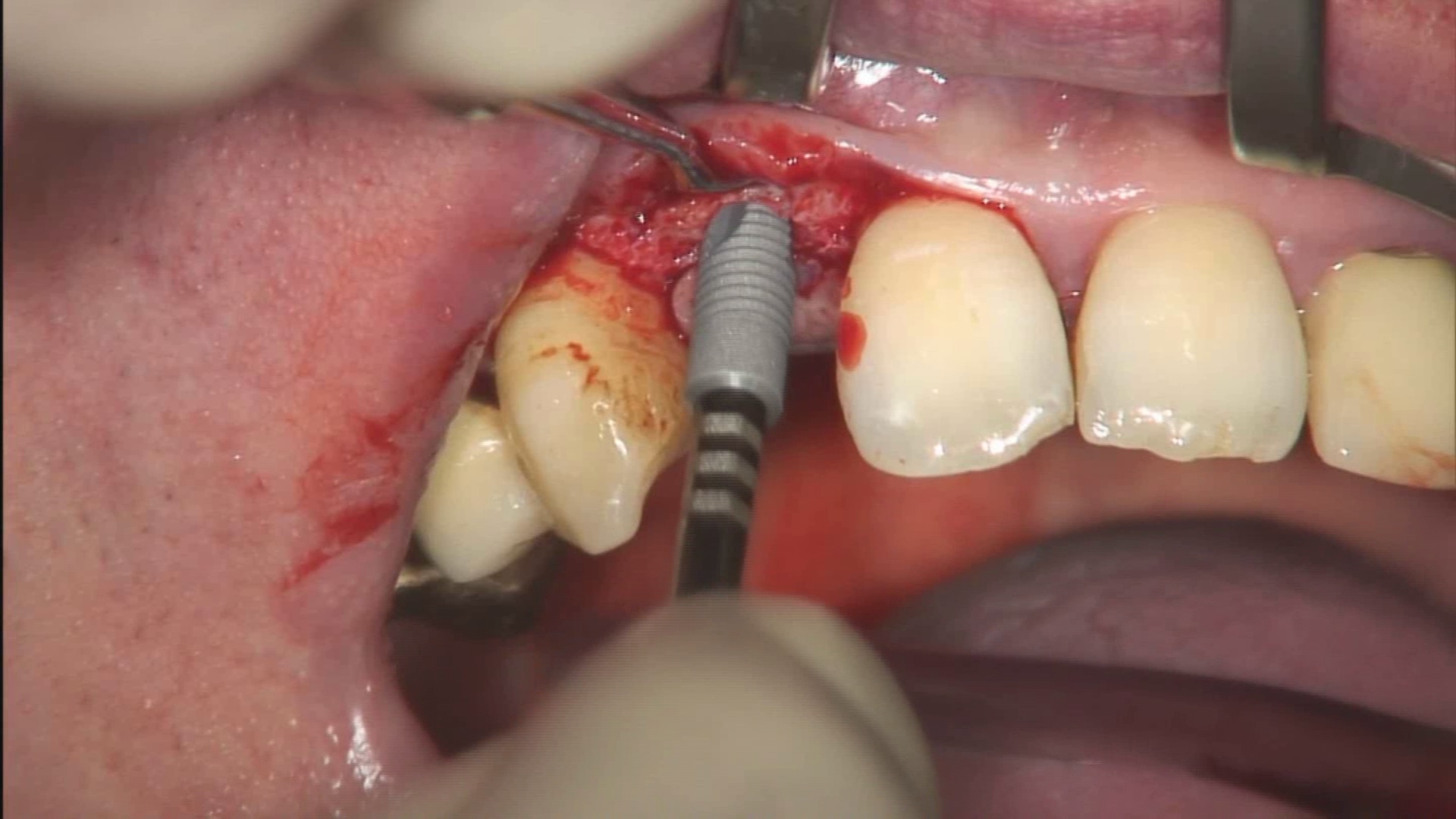 video hd implant insertion